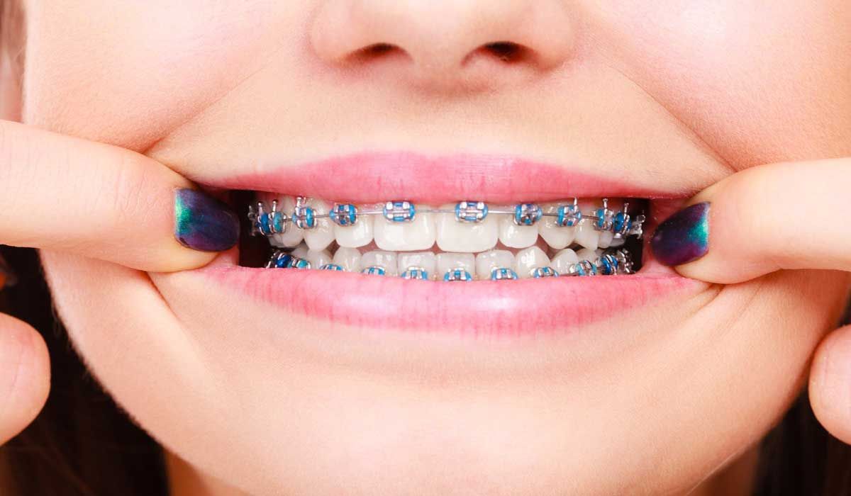 Dental Braces Cost Procedure Recovery and Results