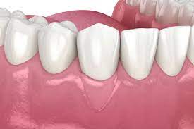 The Gums Depigmented Introduction Gingival Depigmentation