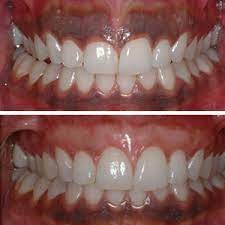 Gums Depigmented