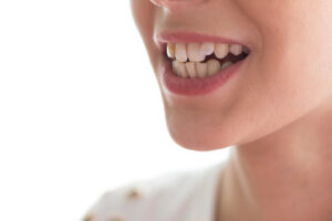 Gums Bleaching