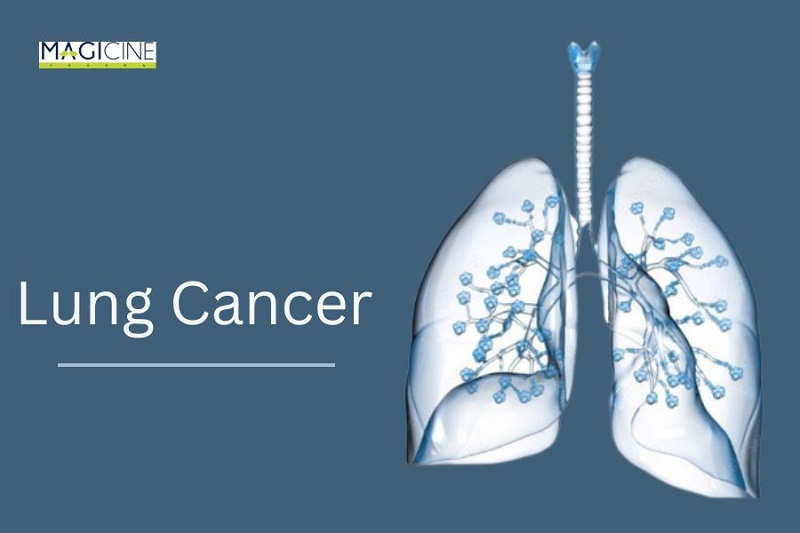 Those myths related to Lung Cancer, about which you should also know
