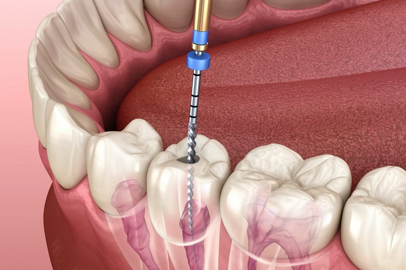 Tips to Prepare Before a Root Canal Treatment