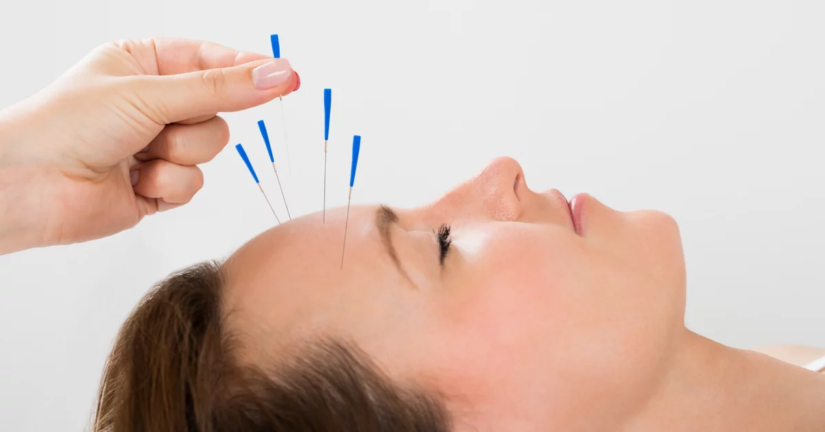 5 Benefits of Northglenn Acupuncture