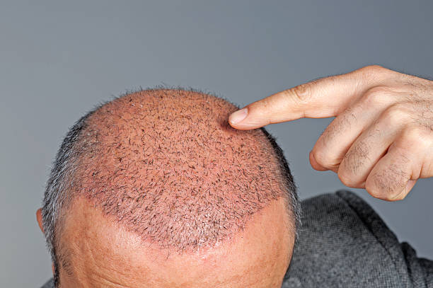 Hair Transplantation in Dubai: Why You Should Get one Done