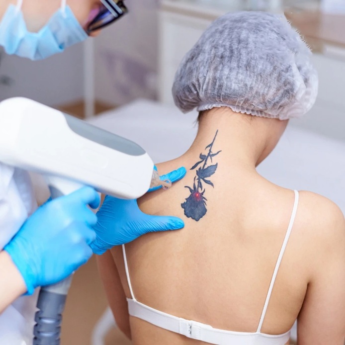 Effective Laser Tattoo Removal Techniques