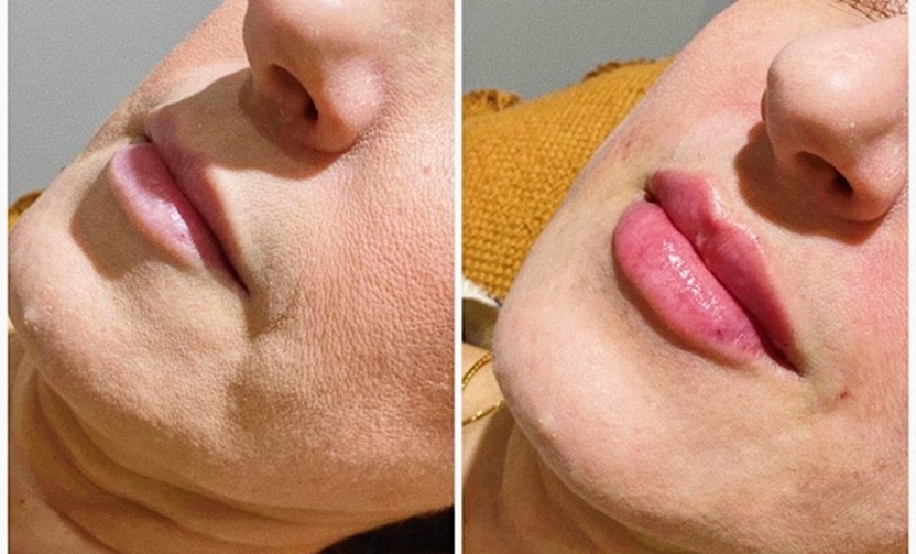 Lip Filler