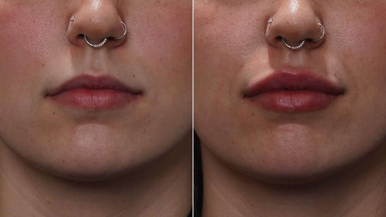 Lip Fillers in Melbourne